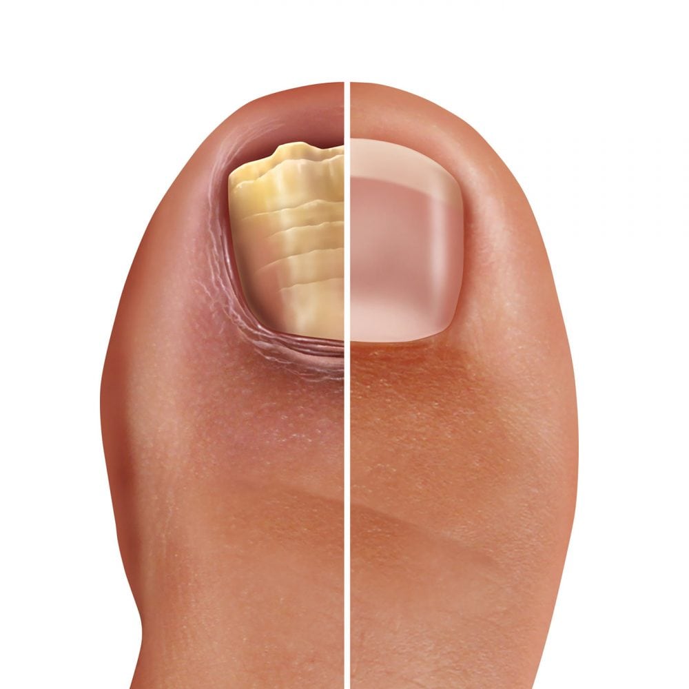 Fungal nail infections