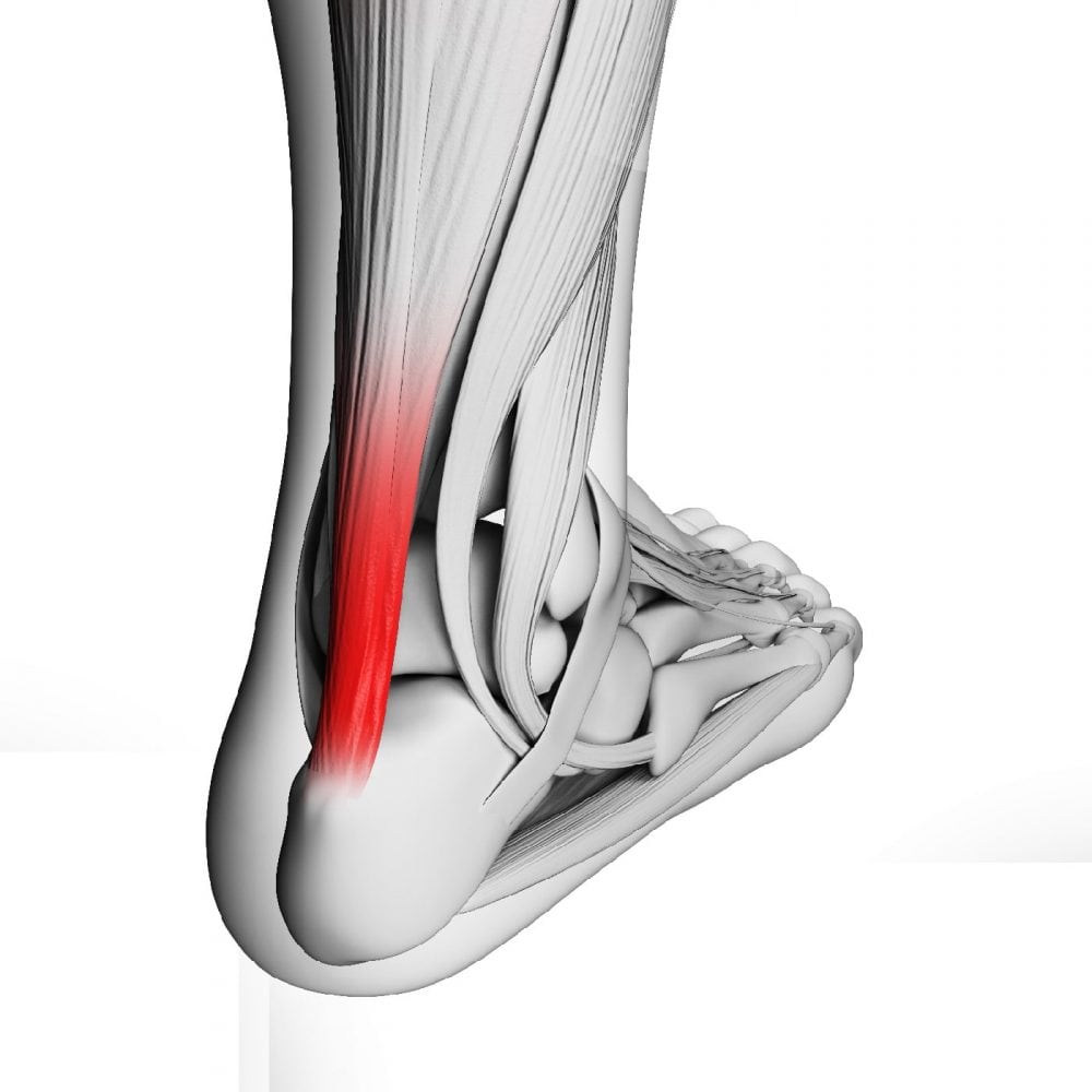 achilles tendon strain treatment