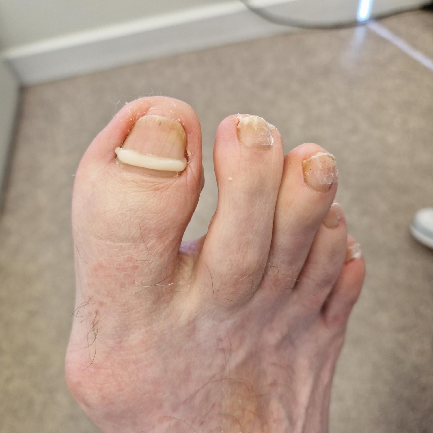 I had an ingrown toenail surgery Wednesday, is this normal? : r/Podiatry