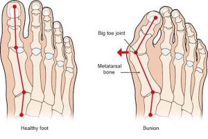 Healthy and bunion foot