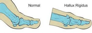 Normal and hallux rigidus