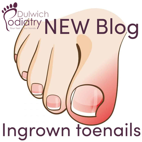 Ingrowing toenails